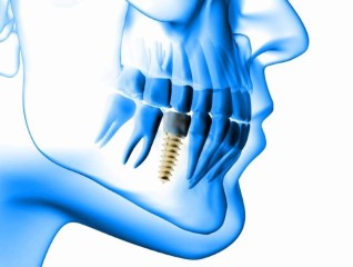 implant1